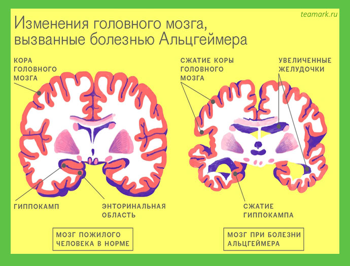 Неврология. Этимология и симптомы протекания болезни Альцгеймера Неврология. Этимология и симптомы протекания болезни Альцгеймера
